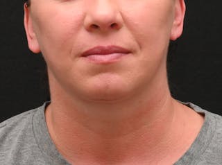 Deep Plane Facelift & Neck Lift Before & After Gallery - Patient 278512 - Image 6