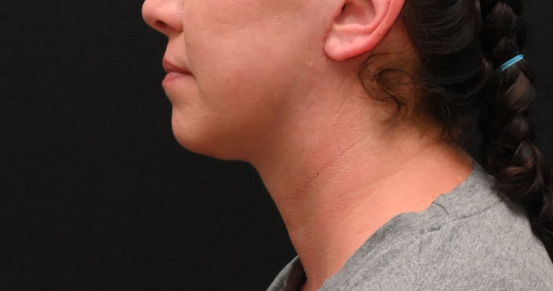 Deep Plane Facelift & Neck Lift Before & After Gallery - Patient 278512 - Image 10