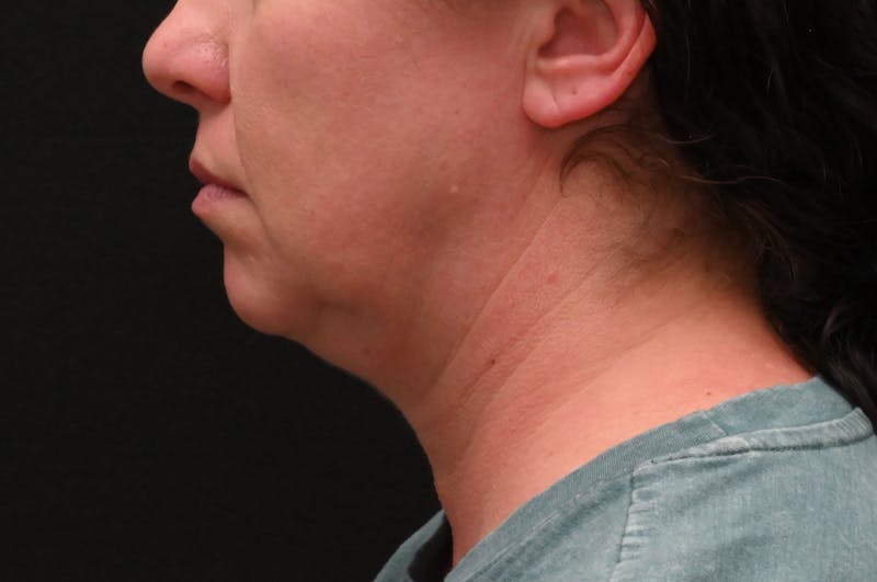 Deep Plane Facelift & Neck Lift Before & After Gallery - Patient 278512 - Image 9