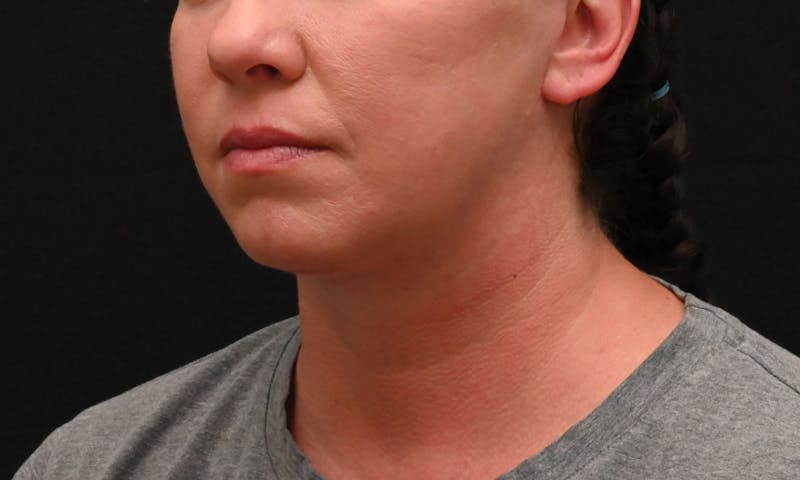Deep Plane Facelift & Neck Lift Before & After Gallery - Patient 278512 - Image 8