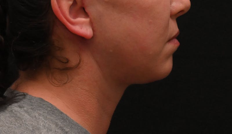 Deep Plane Facelift & Neck Lift Before & After Gallery - Patient 278512 - Image 2