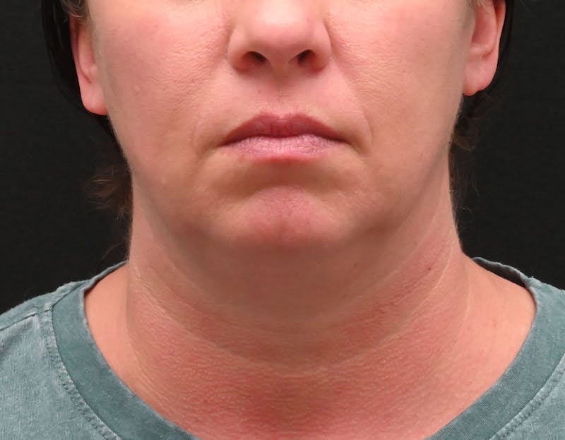 Deep Plane Facelift & Neck Lift Before & After Gallery - Patient 278512 - Image 5