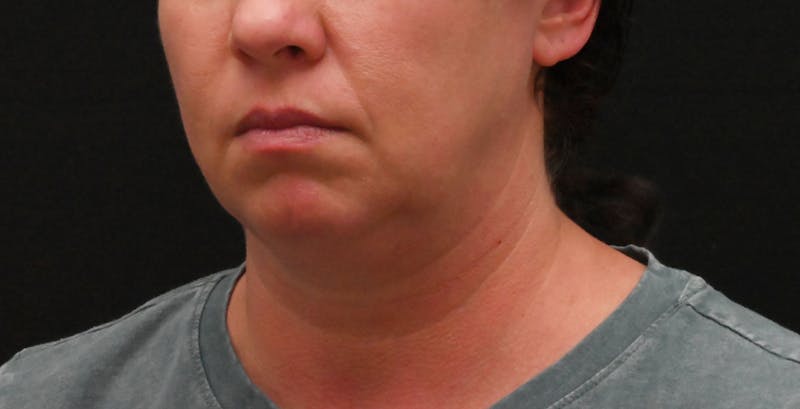 Deep Plane Facelift & Neck Lift Before & After Gallery - Patient 278512 - Image 7