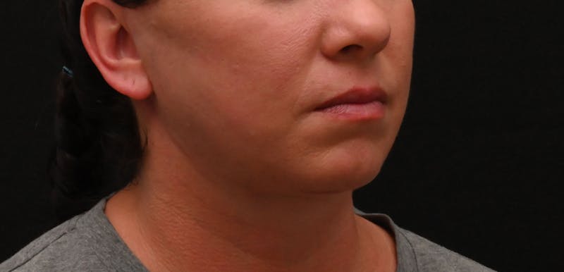 Deep Plane Facelift & Neck Lift Before & After Gallery - Patient 278512 - Image 4