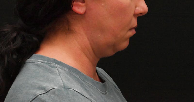 Deep Plane Facelift & Neck Lift Before & After Gallery - Patient 278512 - Image 1