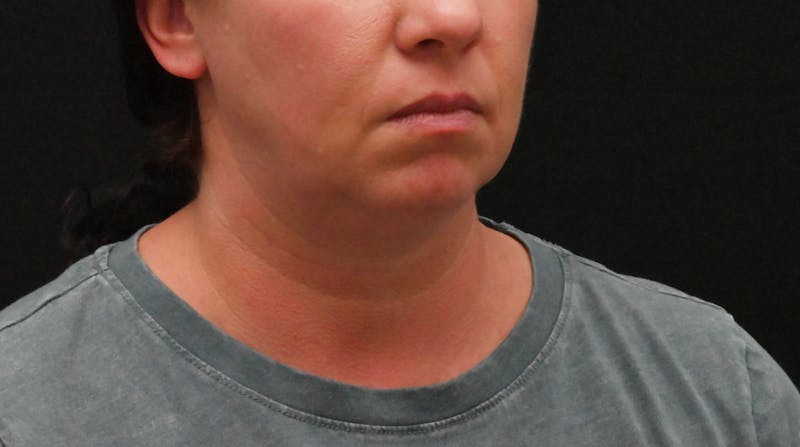 Deep Plane Facelift & Neck Lift Before & After Gallery - Patient 278512 - Image 3