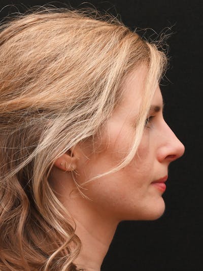 Rhinoplasty Before & After Gallery - Patient 356771 - Image 2