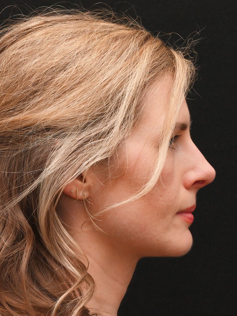 Rhinoplasty Before & After Gallery - Patient 356771 - Image 2