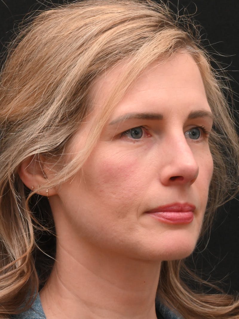 Rhinoplasty Before & After Gallery - Patient 356771 - Image 4