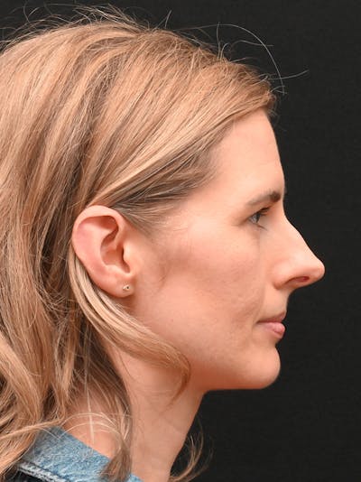 Rhinoplasty Before & After Gallery - Patient 356771 - Image 1