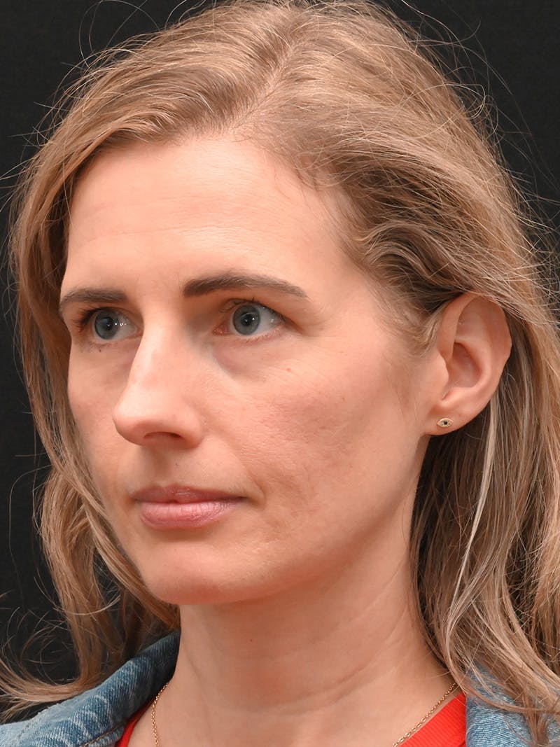 Rhinoplasty Before & After Gallery - Patient 356771 - Image 7