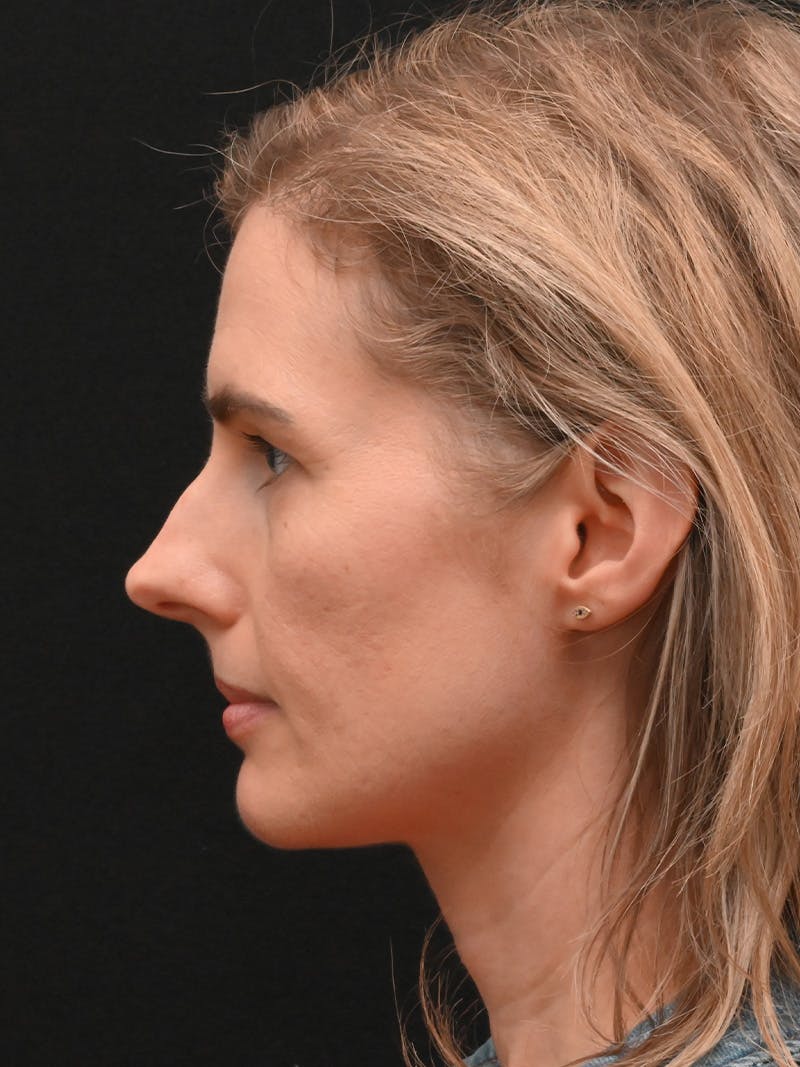 Rhinoplasty Before & After Gallery - Patient 356771 - Image 9