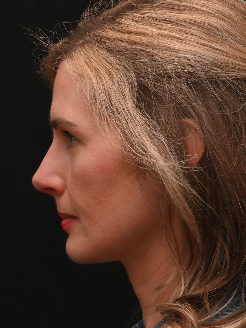 Rhinoplasty Before & After Gallery - Patient 356771 - Image 10