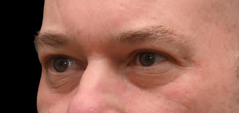 Blepharoplasty (Eyelid Surgery) Before & After Gallery - Patient 404475 - Image 6