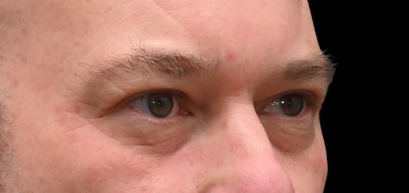 Blepharoplasty (Eyelid Surgery) Before & After Gallery - Patient 404475 - Image 4
