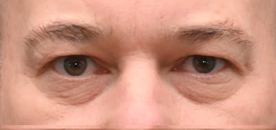 Blepharoplasty (Eyelid Surgery) Before & After Gallery - Patient 404475 - Image 1