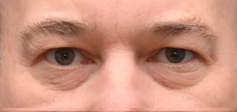 Blepharoplasty (Eyelid Surgery) Before & After Gallery - Patient 404475 - Image 1