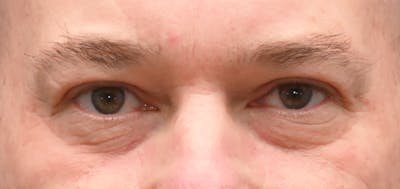 Blepharoplasty (Eyelid Surgery) Before & After Gallery - Patient 404475 - Image 2