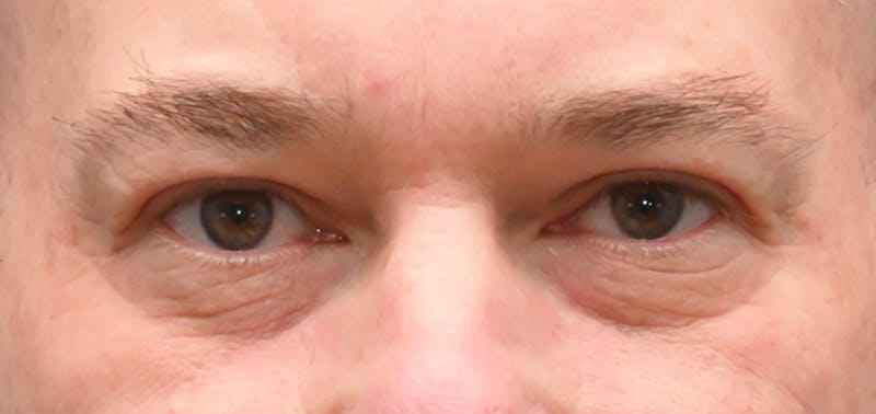 Blepharoplasty (Eyelid Surgery) Before & After Gallery - Patient 404475 - Image 2