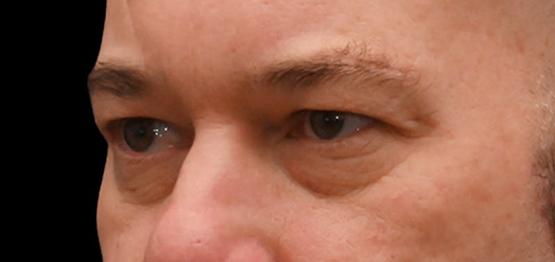 Blepharoplasty (Eyelid Surgery) Before & After Gallery - Patient 404475 - Image 5