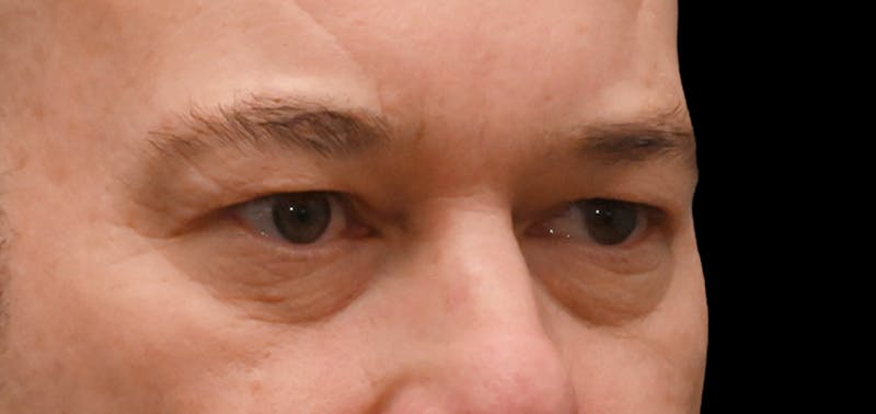Blepharoplasty (Eyelid Surgery) Before & After Gallery - Patient 404475 - Image 3