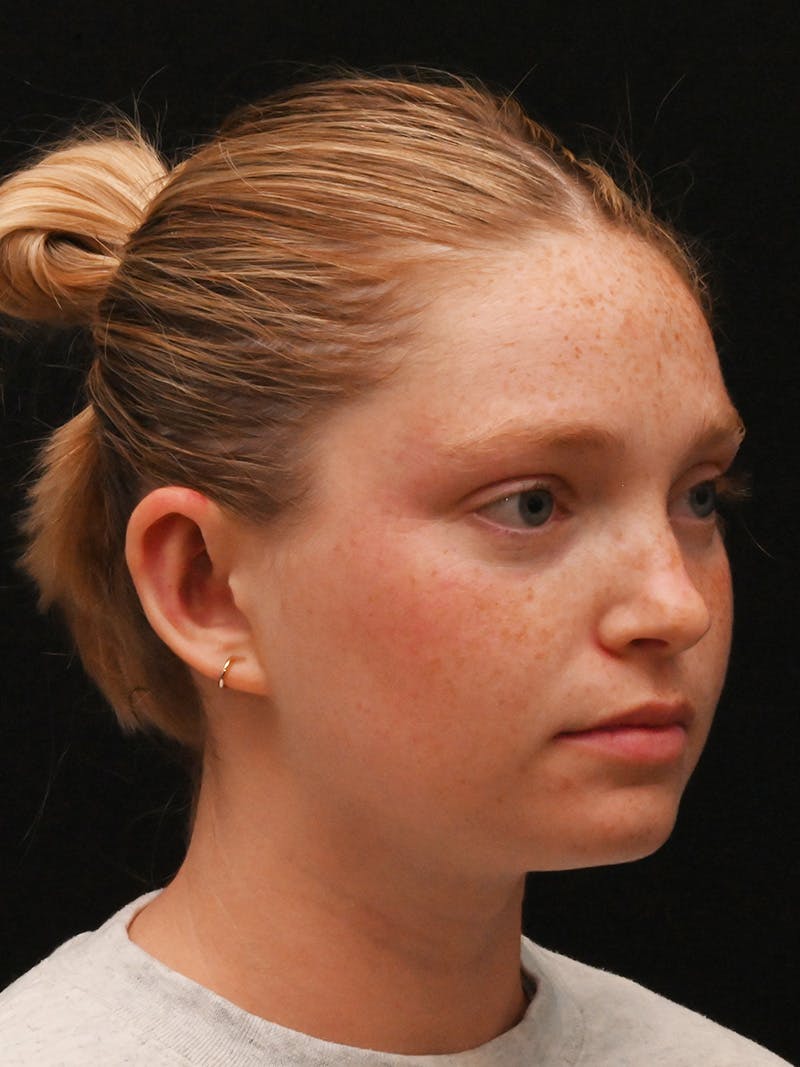 Otoplasty Before & After Gallery - Patient 356798 - Image 4