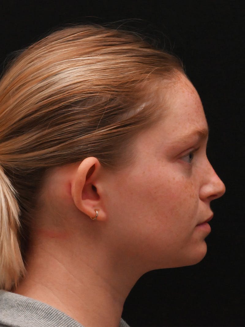 Otoplasty Before & After Gallery - Patient 356798 - Image 5