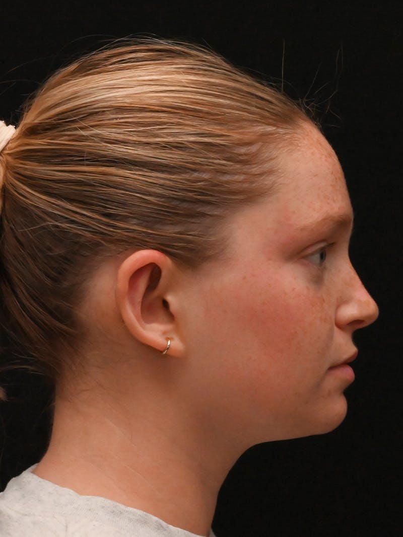 Otoplasty Before & After Gallery - Patient 356798 - Image 6