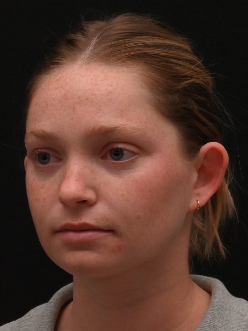 Otoplasty Before & After Gallery - Patient 356798 - Image 7