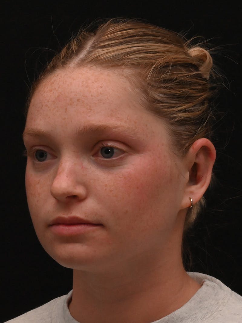Otoplasty Before & After Gallery - Patient 356798 - Image 8