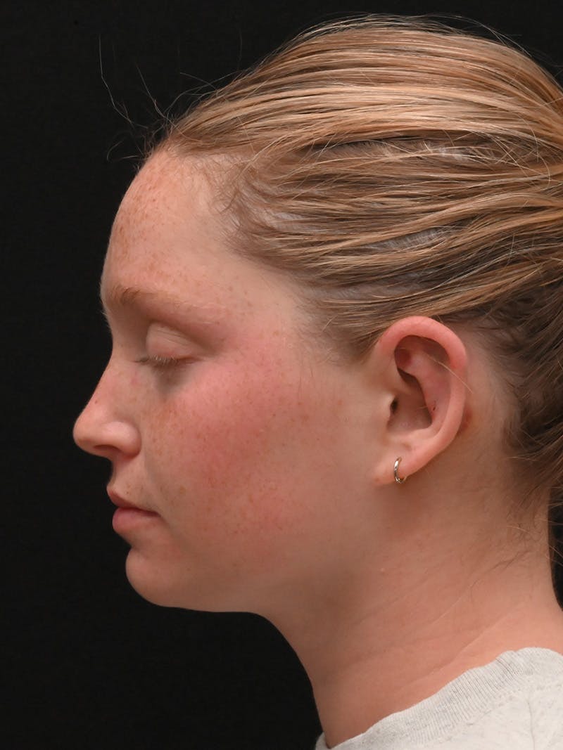 Otoplasty Before & After Gallery - Patient 356798 - Image 10