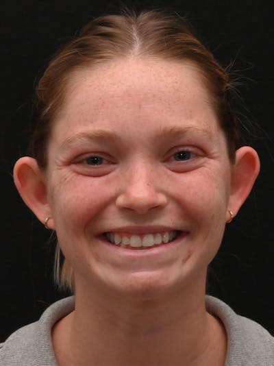 Otoplasty Before & After Gallery - Patient 356798 - Image 1