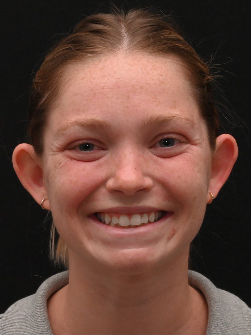 Otoplasty Before & After Gallery - Patient 356798 - Image 1