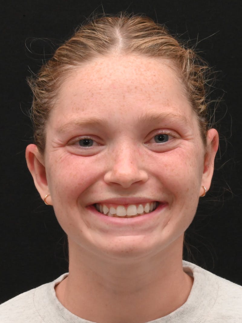 Otoplasty Before & After Gallery - Patient 356798 - Image 2