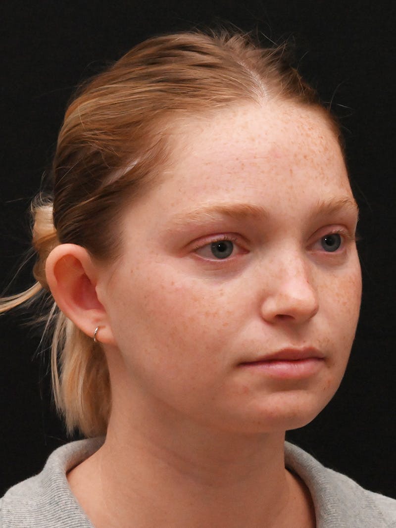 Otoplasty Before & After Gallery - Patient 356798 - Image 3