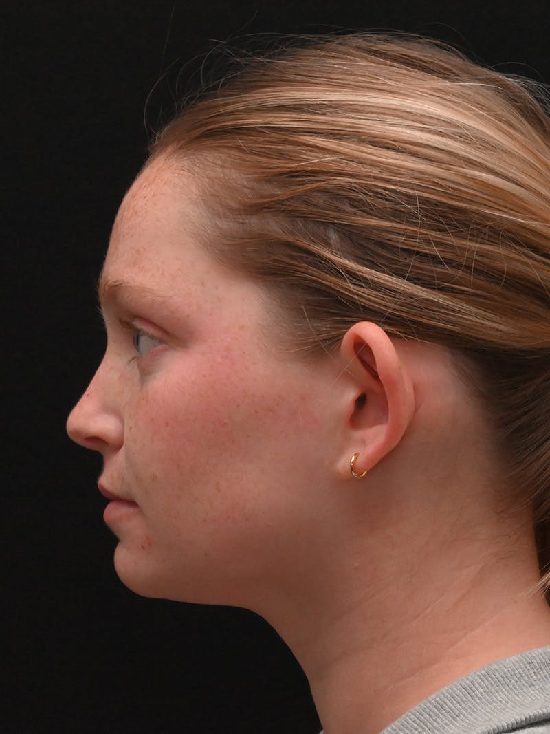 Otoplasty Before & After Gallery - Patient 356798 - Image 9