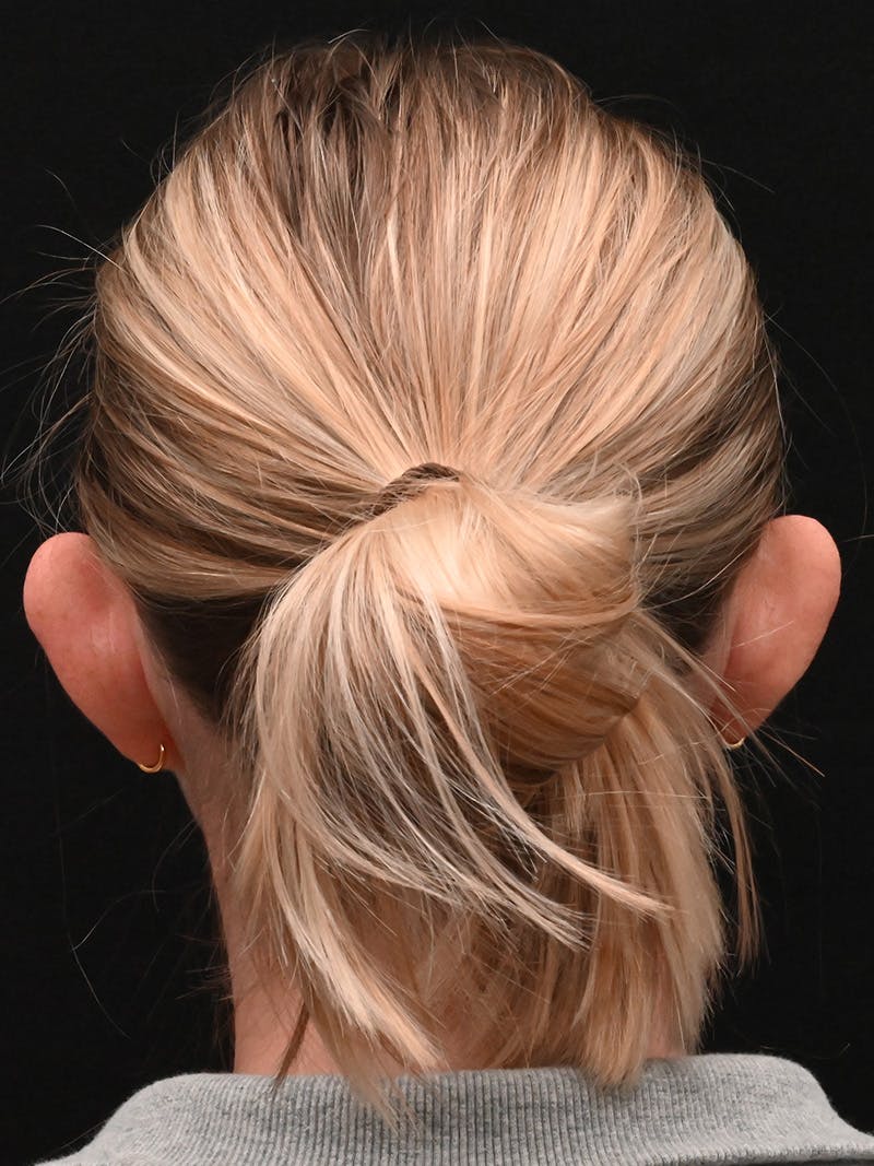 Otoplasty Before & After Gallery - Patient 356798 - Image 11