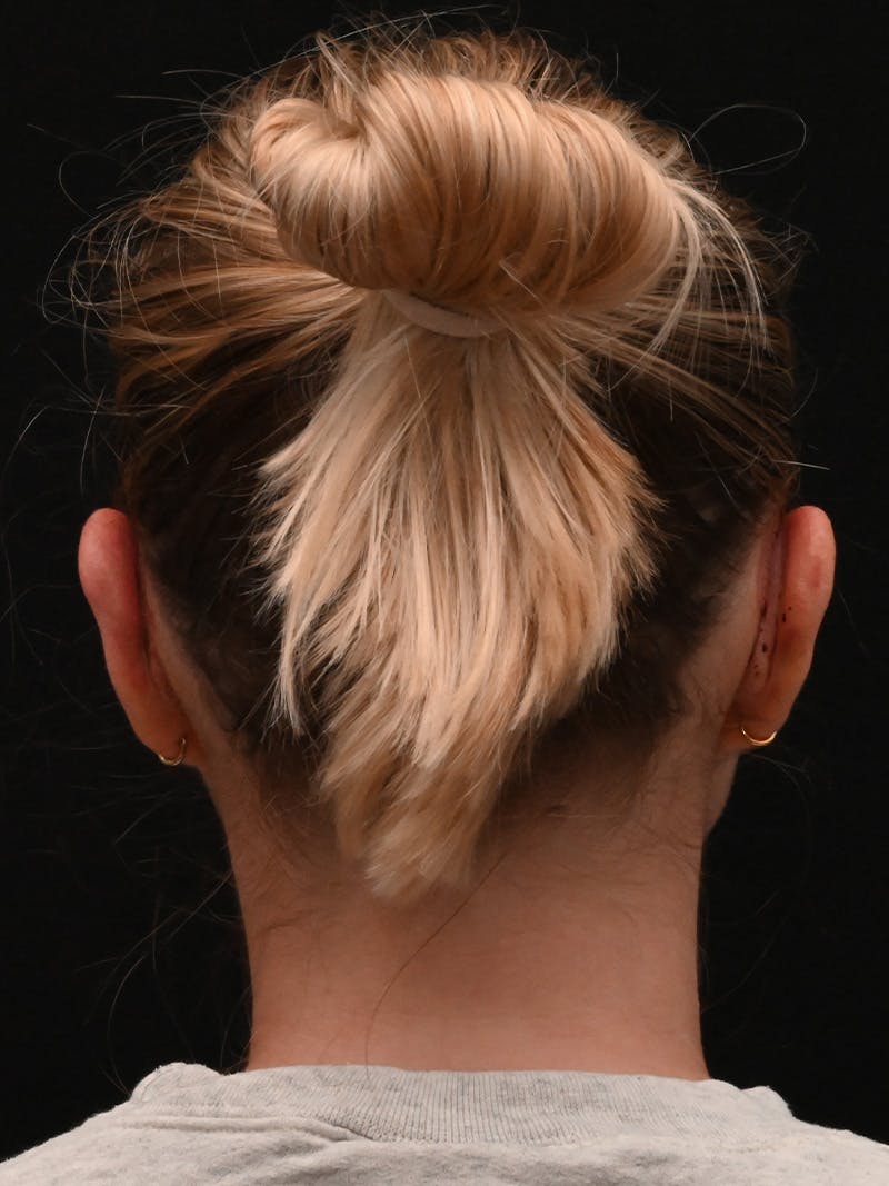 Otoplasty Before & After Gallery - Patient 356798 - Image 12