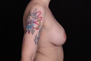 Breast Augmentation with Lift Before & After Gallery - Patient 248315 - Image 6