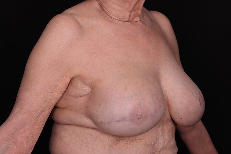 Breast Reconstruction Before & After Gallery - Patient 235495 - Image 4