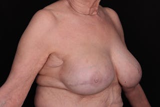 Breast Reconstruction Before & After Gallery - Patient 235495 - Image 4
