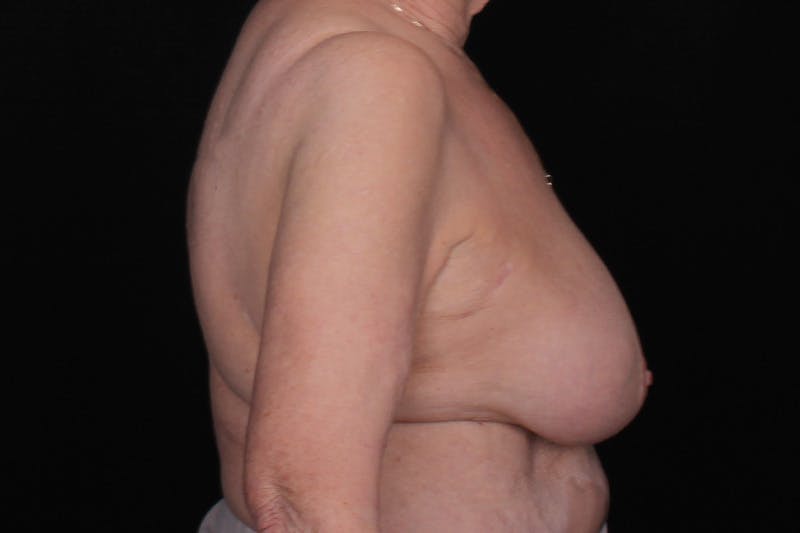 Breast Reconstruction Before & After Gallery - Patient 235495 - Image 5