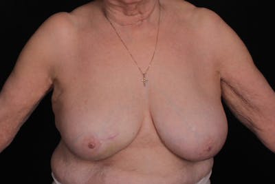 Breast Reconstruction Before & After Gallery - Patient 235495 - Image 1