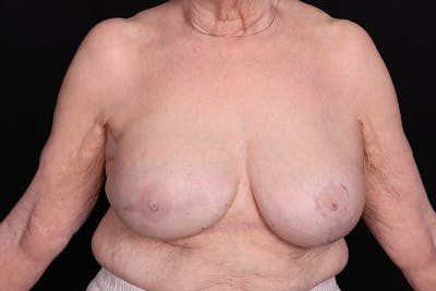 Breast Reconstruction Before & After Gallery - Patient 235495 - Image 2