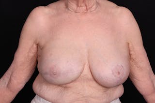 Breast Reconstruction Before & After Gallery - Patient 235495 - Image 2