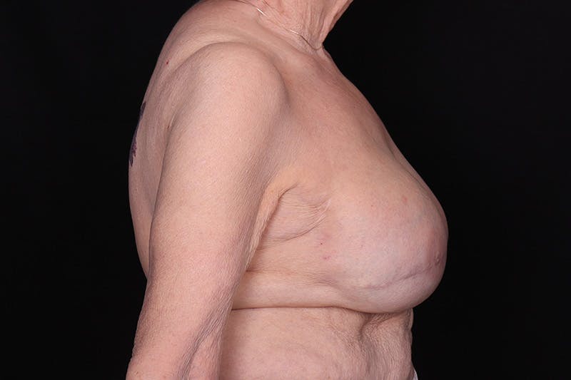 Breast Reconstruction Before & After Gallery - Patient 235495 - Image 6
