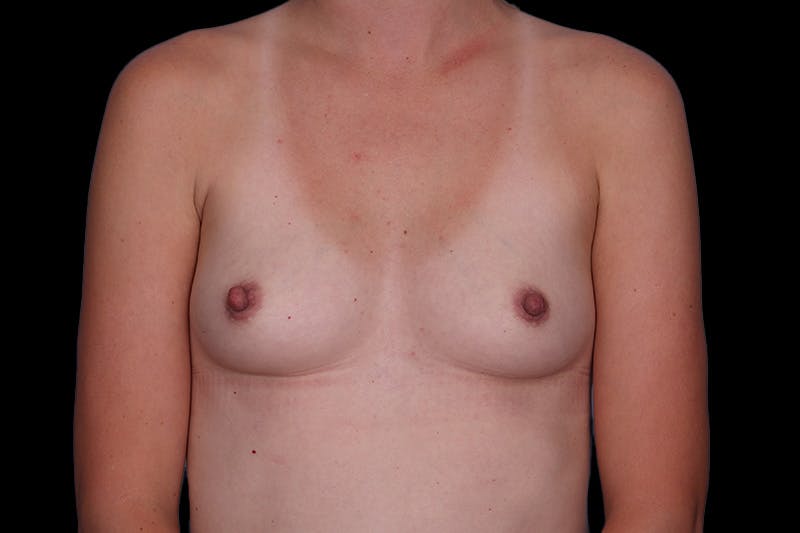 Breast Augmentation Before & After Gallery - Patient 192083 - Image 1