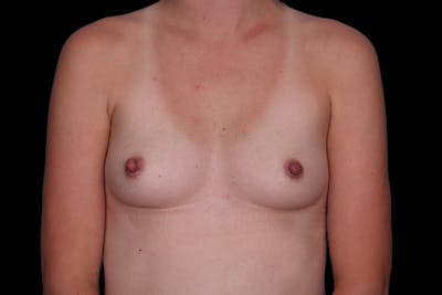 Breast Augmentation Before & After Gallery - Patient 192083 - Image 1