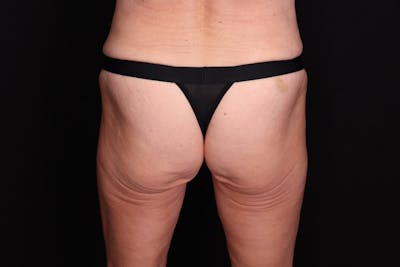 Fat Grafting to Buttock Before & After Gallery - Patient 115415 - Image 1