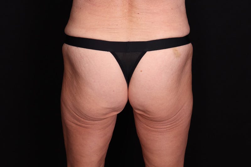 Fat Grafting to Buttock Before & After Gallery - Patient 115415 - Image 1